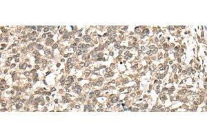 Immunohistochemistry of paraffin-embedded Human esophagus cancer tissue using PHF21A Polyclonal Antibody at dilution of 1:50(x200) (PHF21A 抗体)