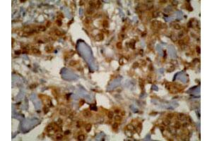 Immunohistochemistry staining of human prostate cancer tissue using CYP3A7 monoclonal antibody, clone F19 P2 H2 . (CYP3A7 抗体  (C-Term))