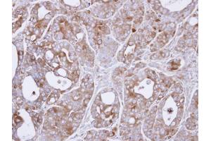 IHC-P Image Immunohistochemical analysis of paraffin-embedded NCIN87 xenograft , using MEKK8(COT), antibody at 1:500 dilution. (MAP3K8 抗体)