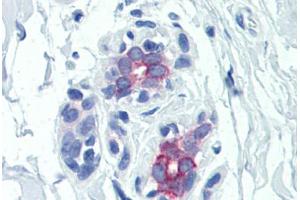 Human Breast (formalin-fixed, paraffin-embedded) stained with PRLR antibody ABIN351557 at 5 ug/ml followed by biotinylated goat anti-rabbit IgG secondary antibody ABIN481713, alkaline phosphatase-streptavidin and chromogen. (Prolactin Receptor 抗体)