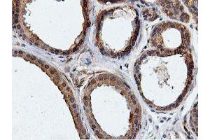 Immunohistochemical staining of paraffin-embedded Human breast tissue using anti-ILVBL mouse monoclonal antibody. (ILVBL 抗体)