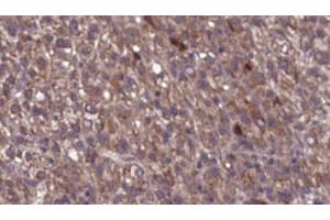 ABIN6276752 at 1/100 staining Human liver cancer tissue by IHC-P. (CHRM1 抗体  (C-Term))