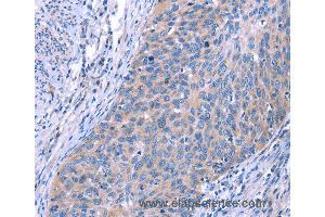 Immunohistochemistry of Human cervical cancer using ESPL1 Polyclonal Antibody at dilution of 1:40 (Separase 抗体)
