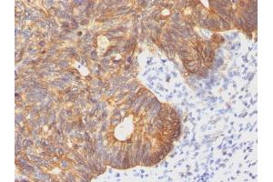 Formalin-fixed, paraffin-embedded human Colon Carcinoma stained with Cytokeratin 8 Mouse Monoclonal Antibody (C-43). (KRT8 抗体)