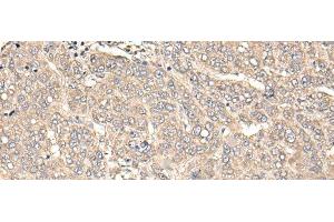 Immunohistochemistry of paraffin-embedded Human liver cancer tissue using C12orf40 Polyclonal Antibody at dilution of 1:50(x200) (C12orf40 抗体)