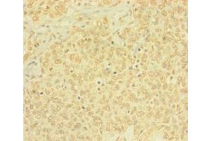 Immunohistochemistry of paraffin-embedded human ovarian cancer using ABIN7165146 at dilution of 1: 100 (BTG4 抗体  (AA 1-206))