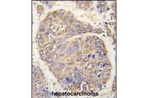 Formalin-fixed and paraffin-embedded human hepatocarcinoma tissue reacted with PBP antibody (N-term) (ABIN392674 and ABIN2842167) , which was peroxidase-conjugated to the secondary antibody, followed by DAB staining. (PEBP1 抗体  (N-Term))