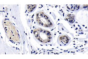 Detection of ATM in Human Breast cancer Tissue using Polyclonal Antibody to Ataxia Telangiectasia Mutated (ATM) (ATM 抗体  (AA 2484-2748))