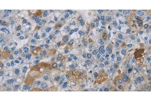 Immunohistochemistry of paraffin-embedded Human liver cancer using DNAJB4 Polyclonal Antibody at dilution of 1:50 (DNAJB4 抗体)