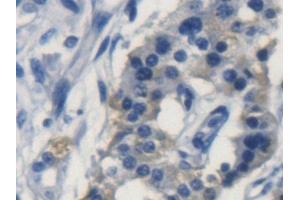 Detection of APOL2 in Human Pancreatic cancer Tissue using Polyclonal Antibody to Apolipoprotein L2 (APOL2)