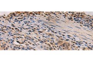 Immunohistochemistry of paraffin-embedded Human esophagus cancer tissue using PDS5B Polyclonal Antibody at dilution of 1:35(x200) (PDS5B 抗体)