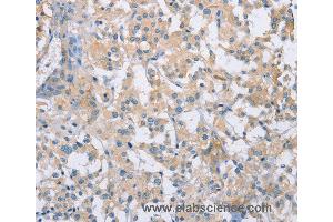 Immunohistochemistry of Human thyroid cancer using CDCP1 Polyclonal Antibody at dilution of 1:50 (CDCP1 抗体)