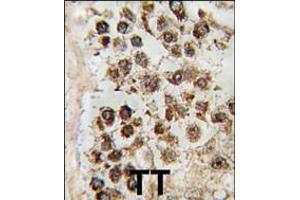 Formalin-fixed and paraffin-embedded human testis tissue reacted with MLLT10 antibody , which was peroxidase-conjugated to the secondary antibody, followed by DAB staining. (MLLT10 抗体  (C-Term))