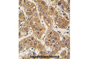 Formalin-fixed and paraffin-embedded human hepatocarcinomareacted with APOE polyclonal antibody , which was peroxidase-conjugated to the secondary antibody, followed by AEC staining. (APOE 抗体  (C-Term))
