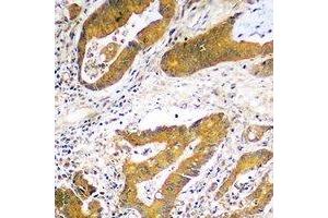 Immunohistochemical analysis of USP48 staining in human colon cancer formalin fixed paraffin embedded tissue section. (USP48 抗体)