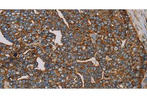 Immunohistochemistry of paraffin-embedded Human cervical cancer using MRPL28 Polyclonal Antibody at dilution of 1:45 (MRPL28 抗体)