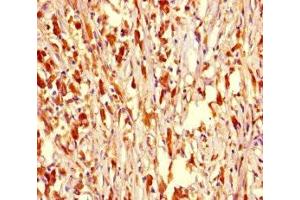 Immunohistochemistry of paraffin-embedded human melanoma using ABIN7162415 at dilution of 1:100 (NR1H2 抗体  (AA 1-461))