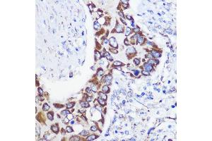 Immunohistochemistry of paraffin-embedded Human lung cancer using MTMR9 Rabbit pAb (ABIN6128253, ABIN6144163, ABIN6144164 and ABIN6217000) at dilution of 1:100 (40x lens). (MTMR9 抗体  (AA 1-250))