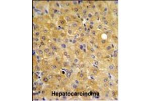 DLG7 Antibody (Center) (ABIN650734 and ABIN2839433) IHC analysis in formalin fixed and paraffin embedded hepatocarcinoma followed by peroxidase conjugation of the secondary antibody and DAB staining. (DLGAP5 抗体  (AA 228-258))