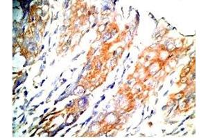 Human colon cancer tissue was stained by Rabbit Anti-GLP-1 (2-24) (Human) Antibody (GLP-1 抗体  (AA 2-24))