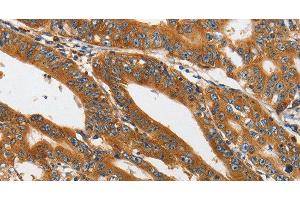 Immunohistochemistry of paraffin-embedded Human gastric cancer tissue using PI 3 Kinase Class 3 Polyclonal Antibody at dilution 1:40 (PIK3C3 抗体)