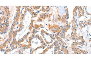Immunohistochemistry of paraffin-embedded Human thyroid cancer tissue using ACSBG1 Polyclonal Antibody at dilution 1:40 (ACSBG1 抗体)
