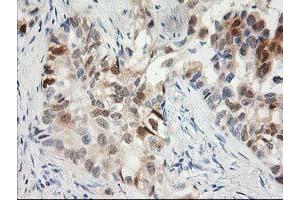 Immunohistochemical staining of paraffin-embedded Carcinoma of Human lung tissue using anti-HPGD mouse monoclonal antibody. (HPGD 抗体)