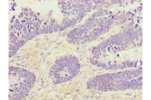 Immunohistochemistry of paraffin-embedded human ovarian cancer using ABIN7166396 at dilution of 1:100 (PADI3 抗体  (AA 1-664))