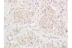 Formalin-fixed and human breast carcinoma tissue labeled with Anti-KLK1 Polyclonal Antibody , Unconjugated at 1:200 followed by conjugation to the secondary antibody and DAB staining (Kallikrein 1 抗体  (AA 101-200))