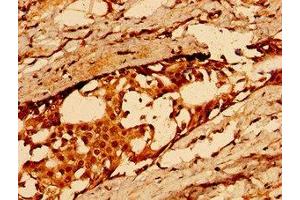 Immunohistochemistry of paraffin-embedded human breast cancer using ABIN7163584 at dilution of 1:100 (CD36 抗体  (AA 191-376))