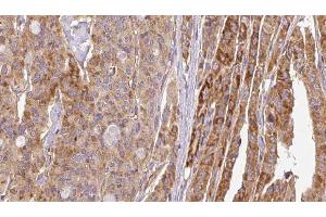 ABIN6267116 at 1/100 staining Human thyroid cancer tissue by IHC-P.