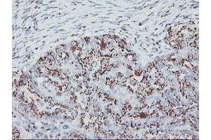 Immunohistochemical staining of paraffin-embedded Adenocarcinoma of Human ovary tissue using anti-GOLM1 mouse monoclonal antibody. (GOLM1 抗体)