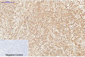 Immunohistochemical analysis of paraffin-embedded human breast cancer tissue. (XRCC4 抗体)