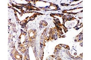 IHC-P: DCC antibody testing of human intestinal cancer tissue (DCC 抗体  (AA 162-178))