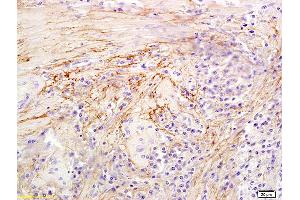 Formalin-fixed and paraffin embedded human colon carcinoma labeled with Anti-Hyaluronidase-1 Polyclonal Antibody, Unconjugated (ABIN673779) at 1:300 followed by conjugation to the secondary antibody and DAB staining (HYAL1 抗体  (AA 271-400))