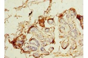 Immunohistochemistry of paraffin-embedded human breast cancer using ABIN7159277 at dilution of 1:100 (MAGEA9 抗体  (AA 1-315))