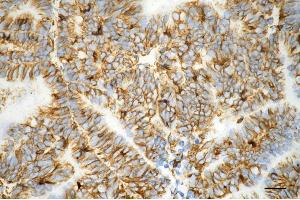 Immunohistochemistry was performed on paraffin-embedded human endometrial carcinoma using vimentin antibody (ABIN7800839), 1:200). (Recombinant Vimentin 抗体)