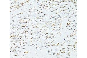 Immunohistochemistry of paraffin-embedded Human uterine cancer using TRIM15 Polyclonal Antibody at dilution of 1:100 (40x lens). (TRIM15 抗体)