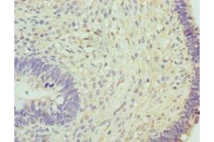 Immunohistochemistry of paraffin-embedded human ovarian cancer using ABIN7160269 at dilution of 1:100 (RNGTT 抗体  (AA 1-260))