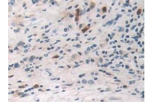 Detection of TNFa in Human Stomach cancer Tissue using Polyclonal Antibody to Tumor Necrosis Factor Alpha (TNFa) (TNF alpha 抗体  (AA 77-233))