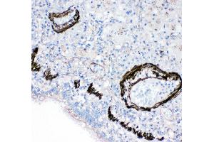 Anti-FABP6 antibody, IHC(P) IHC(P): Human Lung Cancer Tissue (FABP6 抗体  (N-Term))