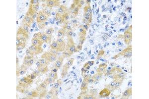 Immunohistochemistry of paraffin-embedded Human liver cancer using Gm13125 Polyclonal Antibody at dilution of 1:100 (40x lens). (Pramel15 抗体)