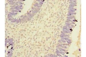 Immunohistochemistry of paraffin-embedded human ovarian cancer using ABIN7146760 at dilution of 1:100 (Carboxypeptidase A2 抗体  (AA 115-419))