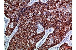 Immunohistochemical analysis of paraffin-embedded Human-lung-cancer, antibody was diluted at 1:100 (EPH Receptor B3 抗体  (AA 650-700))