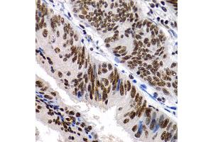 Immunohistochemistry of paraffin-embedded human colon cancer using MT2A antibody (ABIN1873764) at dilution of 1:200 (40x lens). (MT2A 抗体)