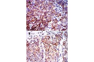 Immunohistochemical analysis of paraffin-embedded human cervical cancer tissue (A) and lung cancer tissue (B) using PPP2R4 monoclonal antobody, clone 4D9  with DAB staining.