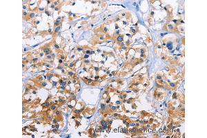 Immunohistochemistry of Human thyroid cancer using CAPZA3 Polyclonal Antibody at dilution of 1:70 (CAPZA3 抗体)