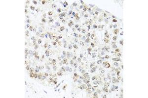 Immunohistochemistry of paraffin-embedded human lung cancer using CETN3 antibody at dilution of 1:100 (x40 lens). (CETN3 抗体)