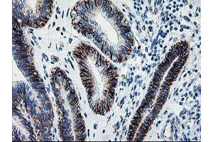 Immunohistochemical staining of paraffin-embedded Adenocarcinoma of Human endometrium tissue using anti-SOCS3 mouse monoclonal antibody. (SOCS3 抗体)