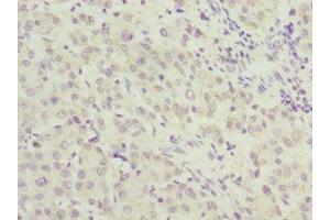 Immunohistochemistry of paraffin-embedded human liver cancer using ABIN7167643 at dilution of 1:100 (RENT2/UPF2 抗体  (AA 1153-1272))